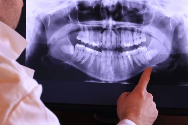 Best Emergency Wisdom Teeth Removal in Shenandoah Heights, PA